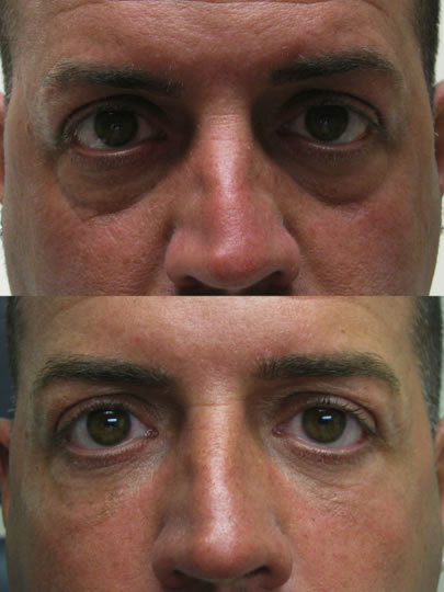 Eye Dark Circles correction at PERFECT FACE